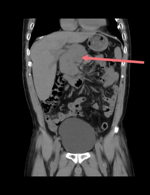 腹腔深部包块CT冠状位图像.jpg