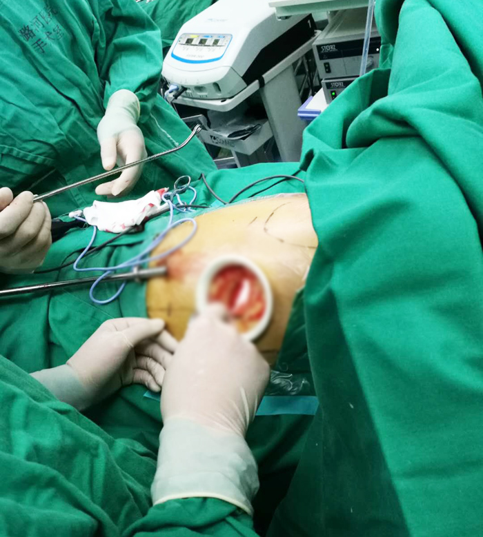 t切胸手术图片