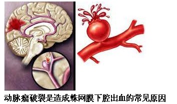 蛛網膜下腔出血最常見的原因為顱內動脈瘤和腦(脊髓)血管畸形,兩者約